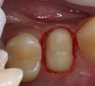 Установка коронки на пролеченный зуб - До