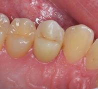 Установка коронки на пролеченный зуб - После